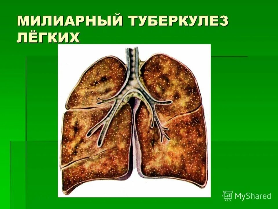 Милиарный диссеминированный туберкулез. Милиарный и очаговый туберкулез. Милиарный туберкулез легких. Миллиардный туберкулещ оешких. Легкие человека с туберкулезом