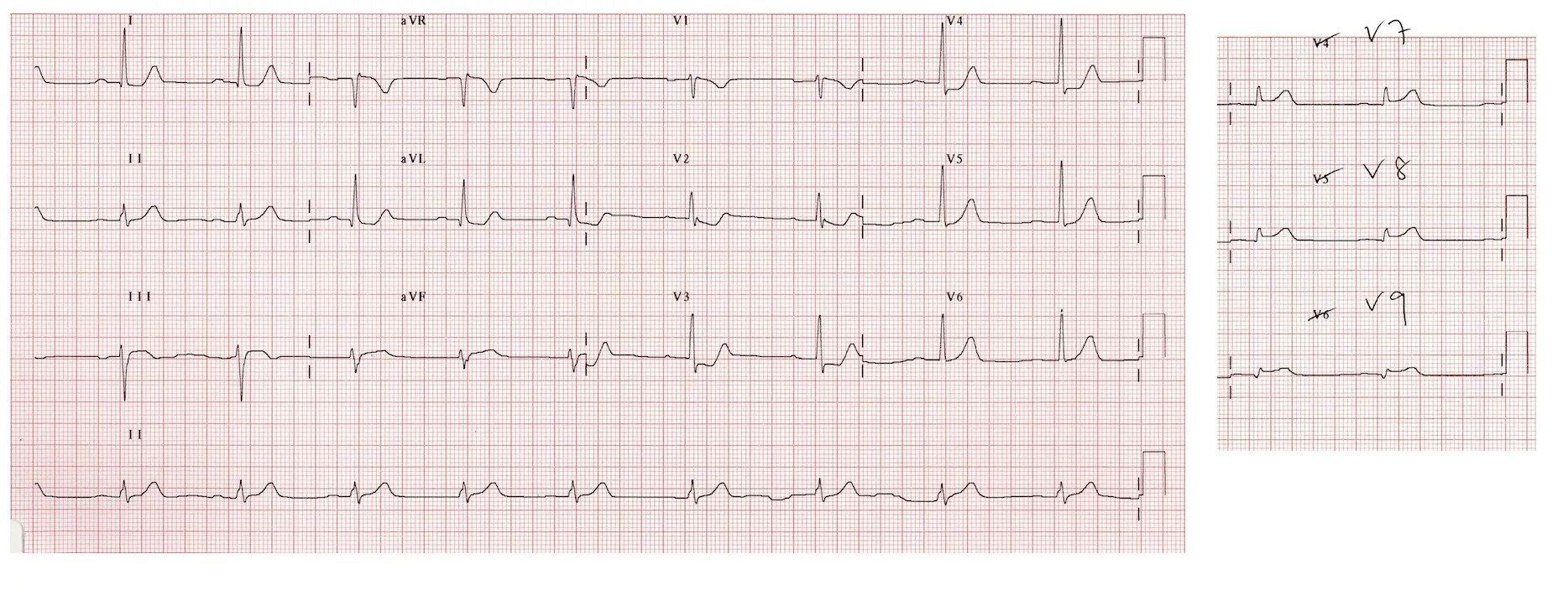 Экг подъем. ЭКГ острый инфаркт миокарда с подъемом St. Подъем сегмента St на ЭКГ v1 v2. Инфаркт миокарда с подъемом сегмента St ЭКГ. Подъем сегмента St в отведениях v2-v3-v.