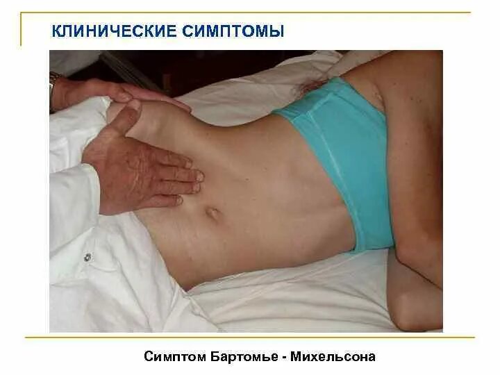 Аппендицит бывает у женщин. Симптомы аппендицита у женщин.