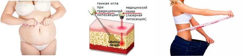 Липосакция в брянске. Лазерный липолиз. лазерная липосакция как проводится.