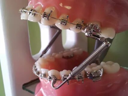 Ортодонтическая коррекция несъемным ортодонтическим аппаратом
