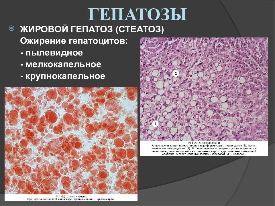 Перерождение клеток печени. Жировая дистрофия печени(жировой гепатоз). Жировой гепатоз печени гистология. Стеатоз печени гистология. Жировой гепатоз биопсия печени.