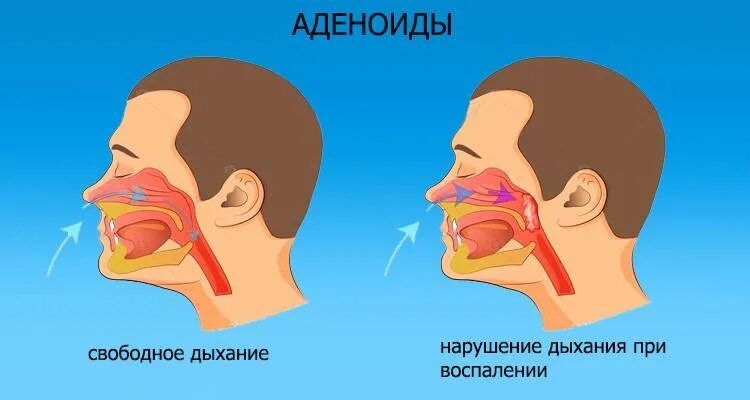 Дышит ртом соплей нет