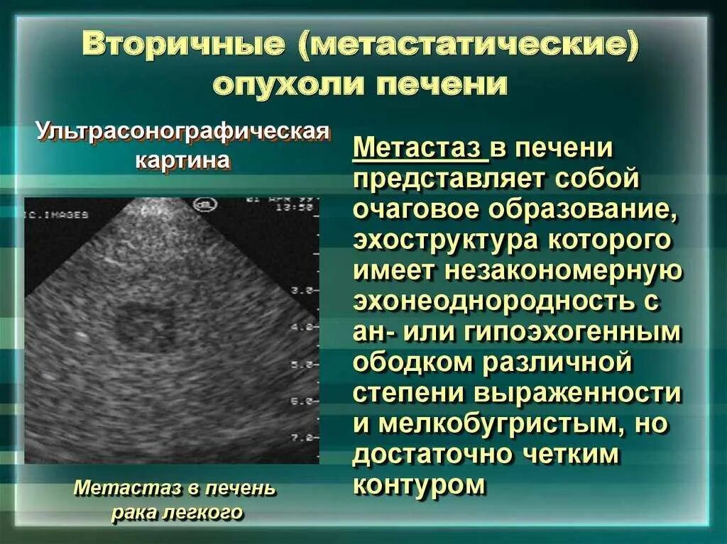 Могут ли метастазы перепутать