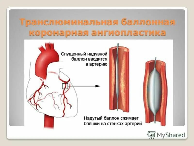 Транслюминальная баллонная ангиопластика