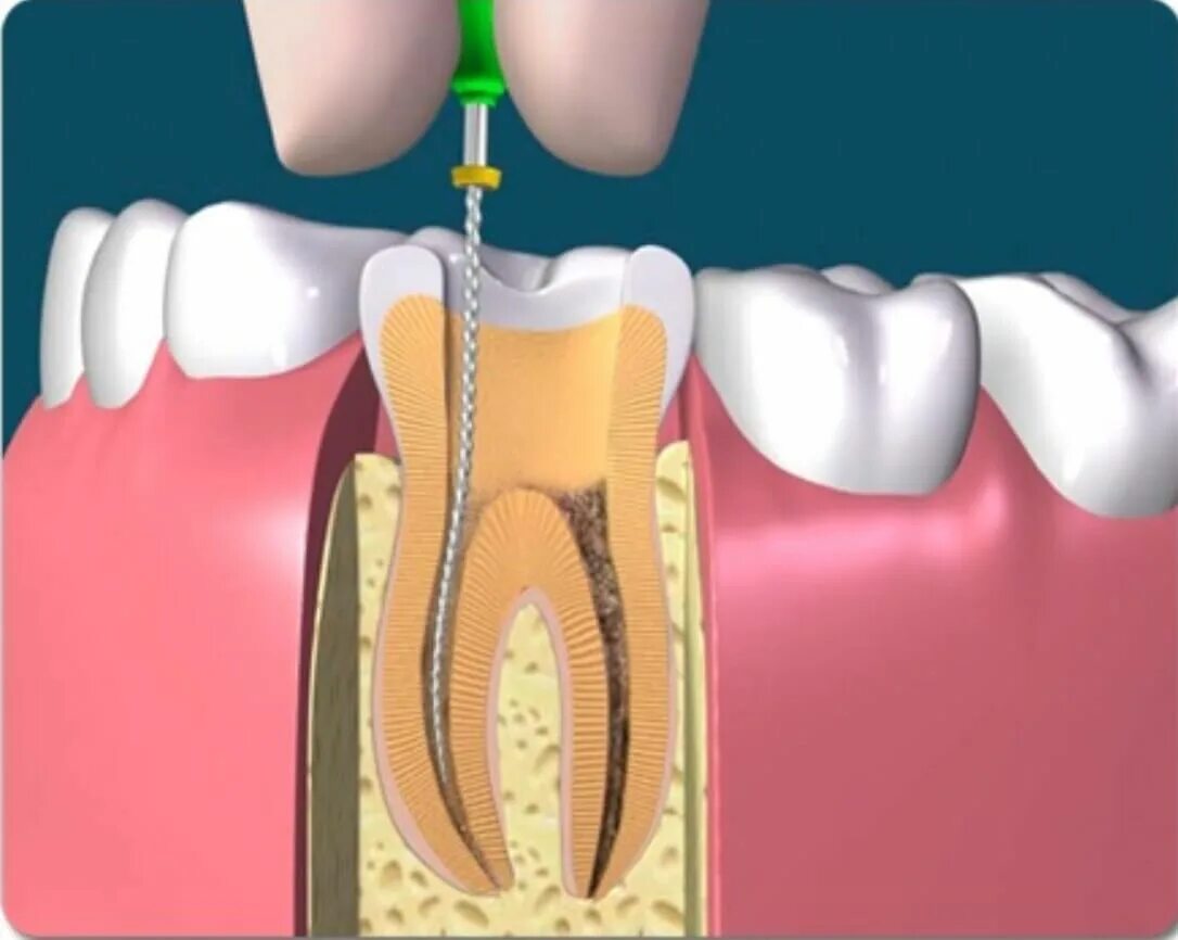 Root canal. Аппарат для чистки каналов зуба.