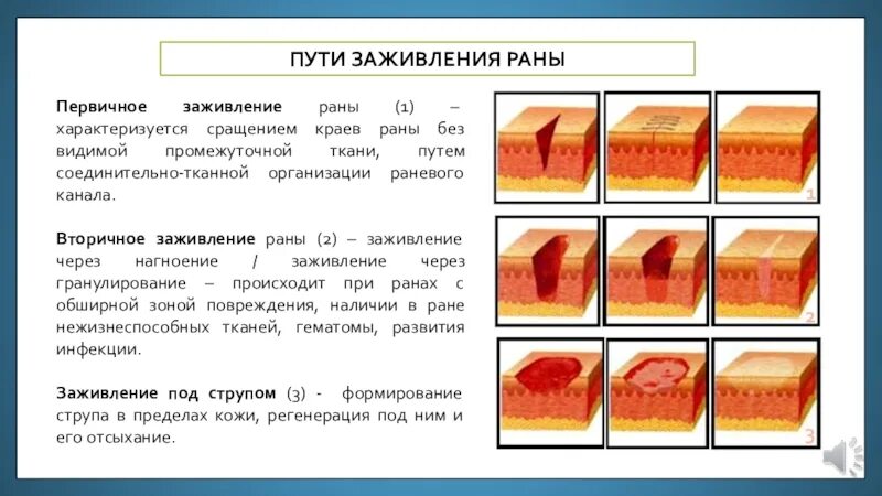 Сколько заживает глубокий. Схема процесса заживления раны. Заживление первичным вторичным заживлением. Этапы заживления первичным и вторичным натяжением. Процесс заживления РАН соединительной тканью это что.