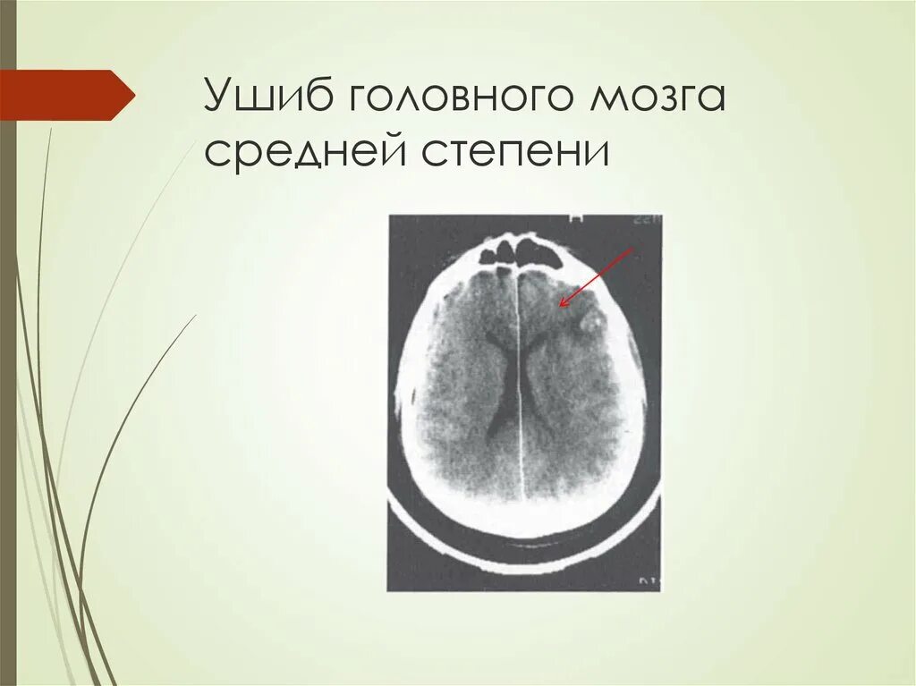 Повреждения головного мозга возникают. Средний ушиб головного мозга. Ушиб головного мозга средней степени тяжести кт.