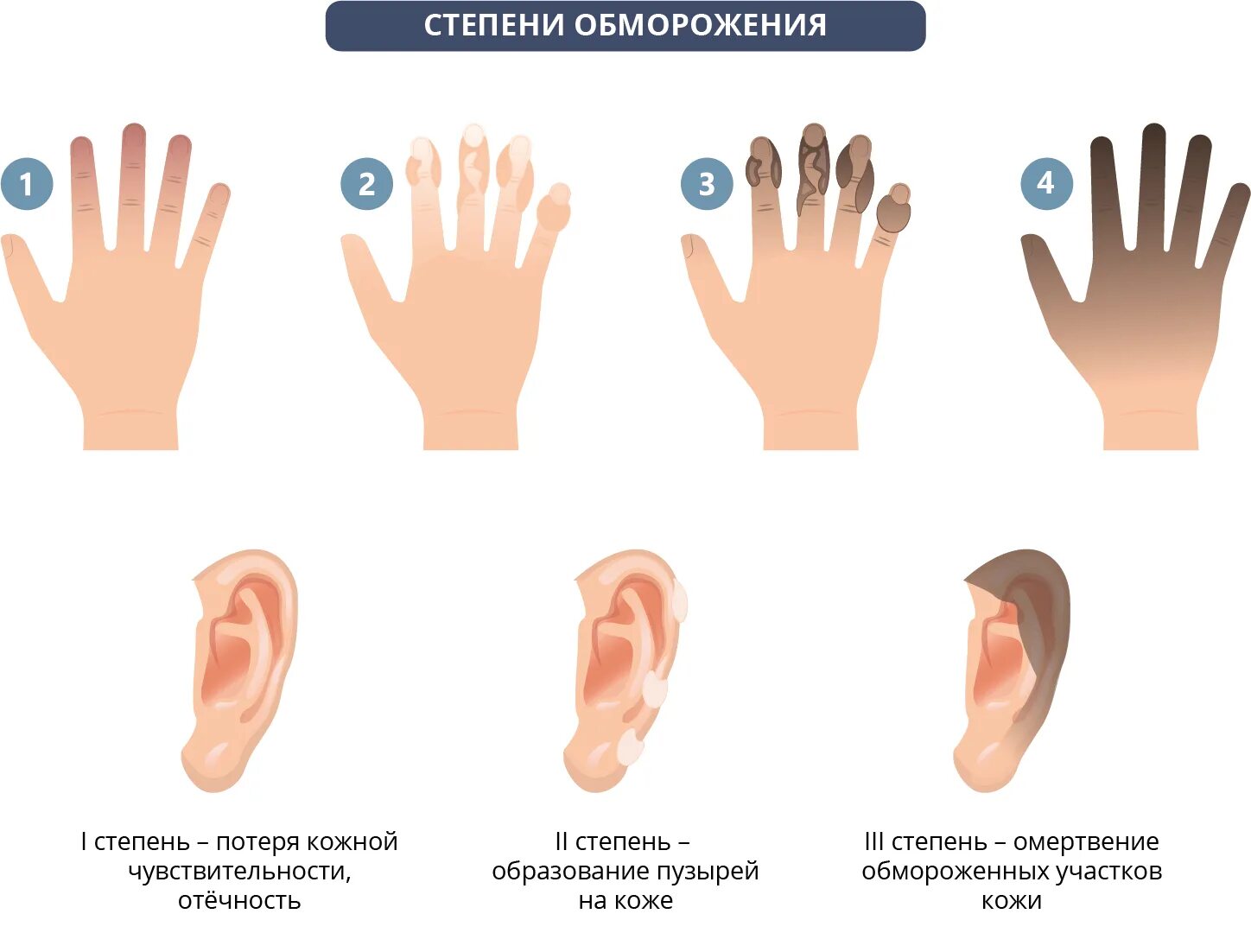 Ознобление. Обморожение 1 степени симптомы. Отморожение 1 и 2 степени. Обморожение 1 степень степень. Обморожение 2-3 степени.