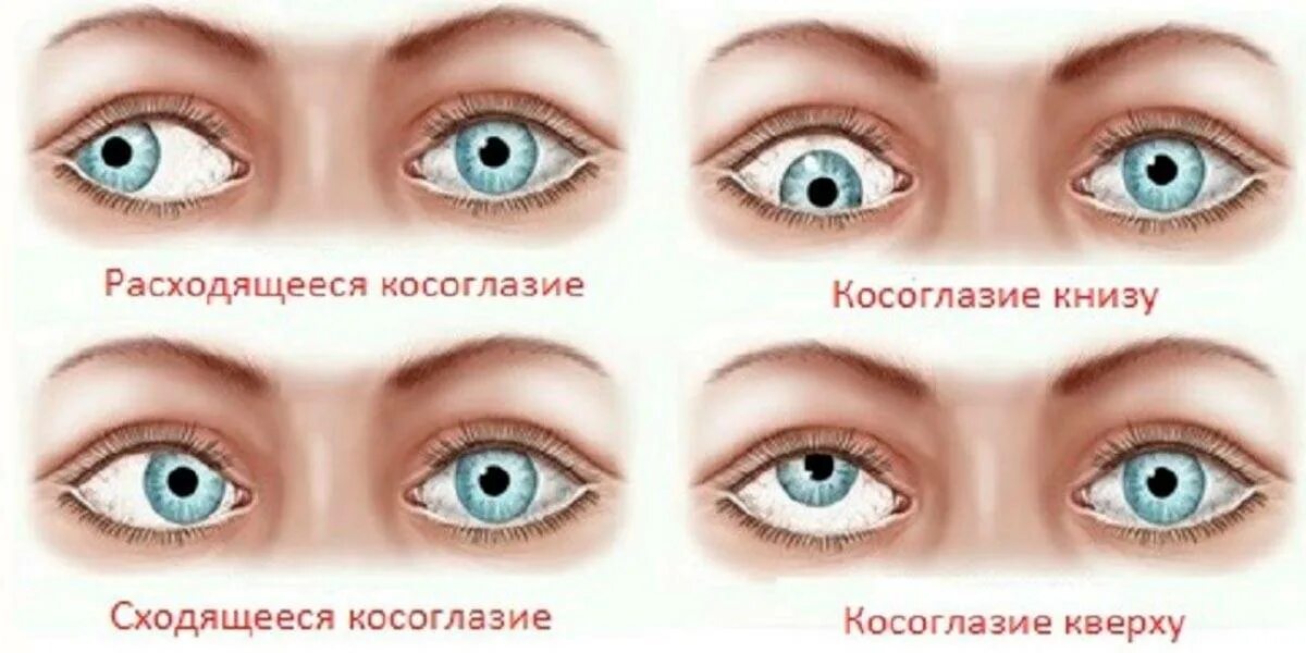 Косит глаз как называется