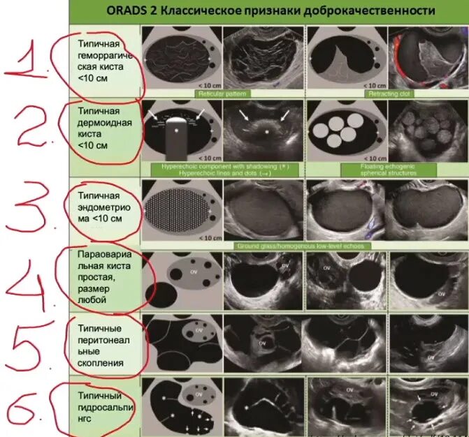 О РАДС классификация УЗИ яичников. O-rads яичники. O rads классификация. Классификация o-rads для УЗИ. Киста яичника o rads