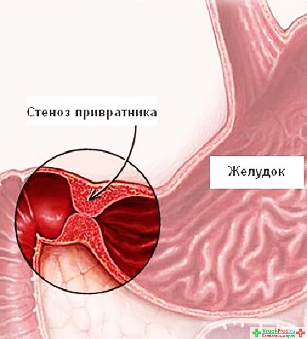 Стеноз кишечника что это. Болезни желудка стеноз привратника. Стеноз привратника язвы желудка. Рубцовый стеноз привратника. Рубцовый пилоростеноз.