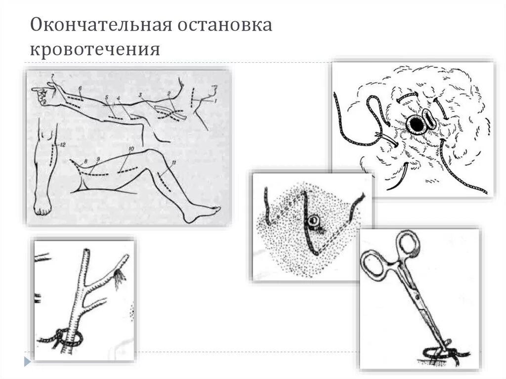 Механические методы остановки кровотечения. Механический метод остановки кровотечения. Механические методы окончательной остановки кровотечения. Способы окончательного кровотечения.