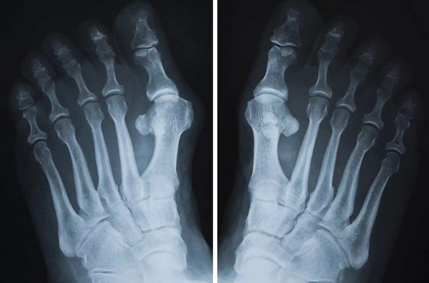 Трещина кости на ноге. Рентген плюсны и фаланг пальцев стоп. Артрит 1 плюснефалангового сустава рентген. Деформирующий остеоартроз стопы рентген. Вальгусная деформация плюснефалангового сустава.