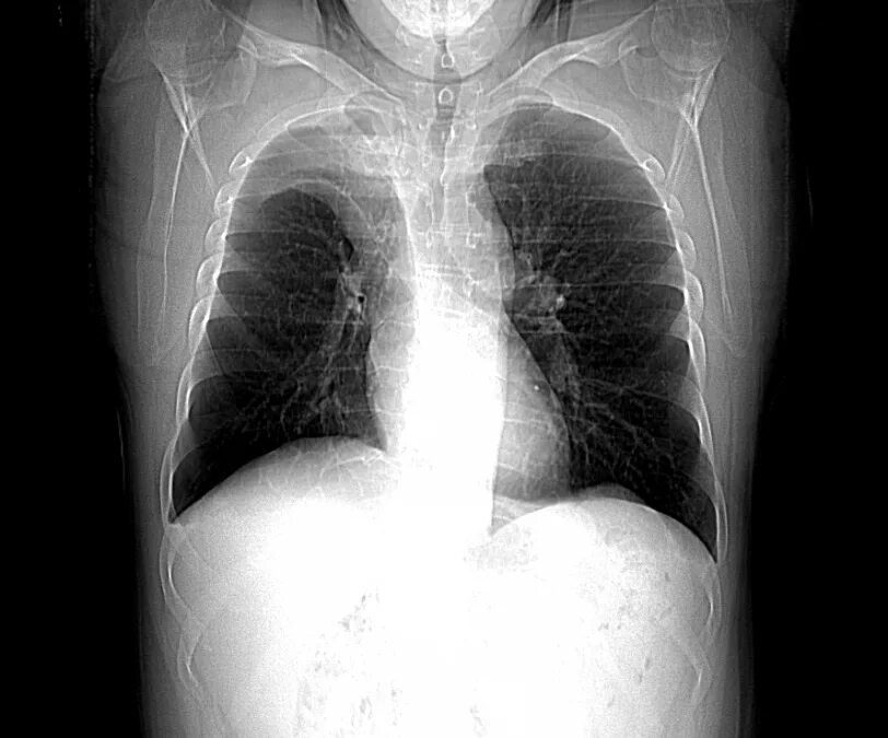К т 2 легких. Кт при пневмонии коронавируса. К т 2 легких. Коронавирусная пневмония на кт. Пневмония коронавирус кт.