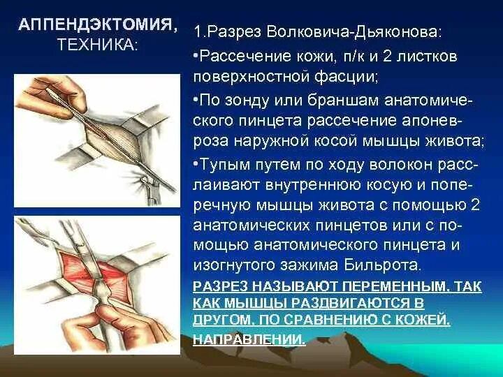 Операция вызывает изменения. Аппендэктомия Волкович. Аппендэктомия разрез Волковича-Дьяконова. Аппендэктомия этапы операции. Аппендэктомия по Волковичу Дьяконову.