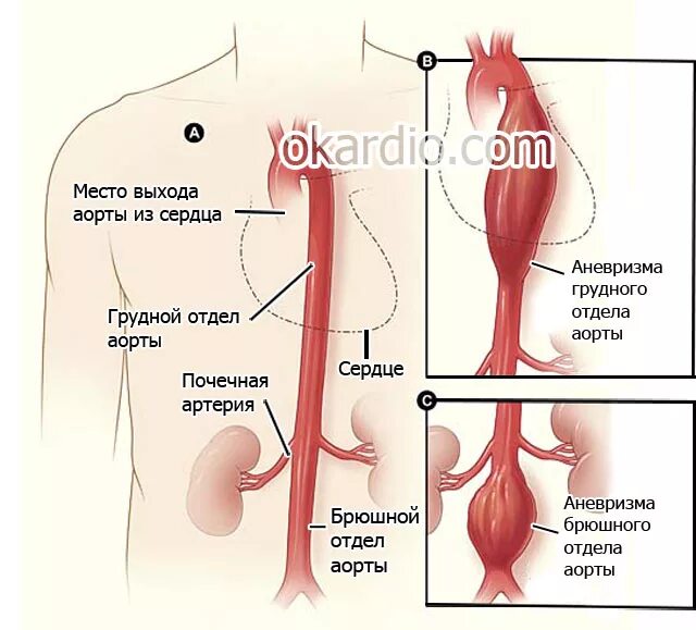 Грудной отдел аорты. Аневризмы брюшного отдела аорты. классификация аневризм грудной аорты. клинические проявления аневризм аорты. аневризма отдел аорты отделы.