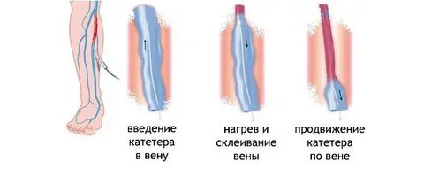 Воздух в венах