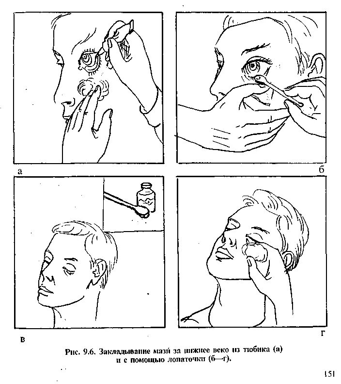 Уход за глазами алгоритм. Техника закладывания глазной мази. Закладывание мази в глаза алгоритм. Закладывание мази на нижнее веко алгоритм. Закладывание мази за веко алгоритм.