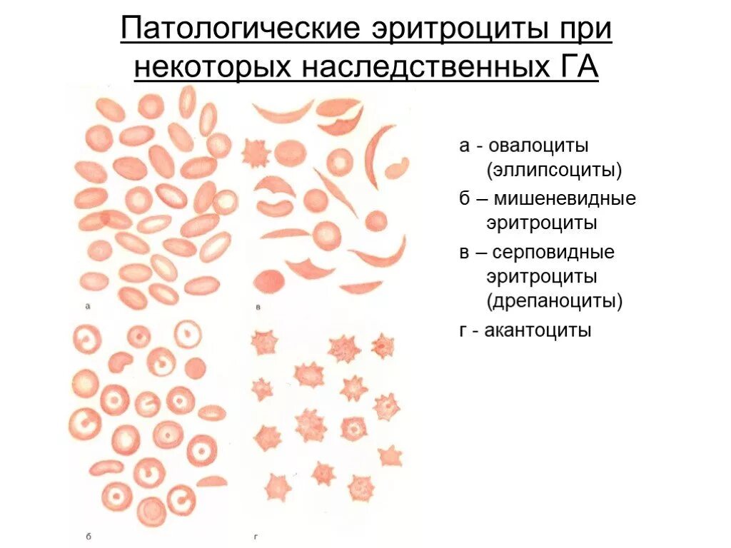Виды изменения эритроцитов. Серповидноклеточная анемия мазок крови. патологические формы эритроцитов периферической крови. морфологические изменения эритроцитов при анемиях. патологические формы эритроцитов пойкилоцитоз.