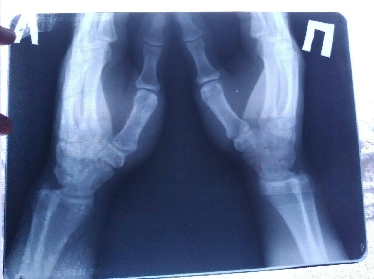 Зона роста ноги на рентгене.