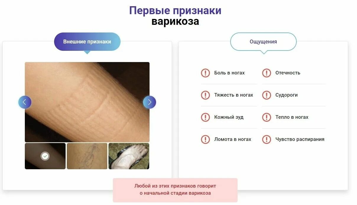 Первые признаки варикоза. Симптомы варикоза на ногах у женщин признаки. Начальные признаки сакроэлеита. Обувь при варикозе. Причина расширение вен на ногах.
