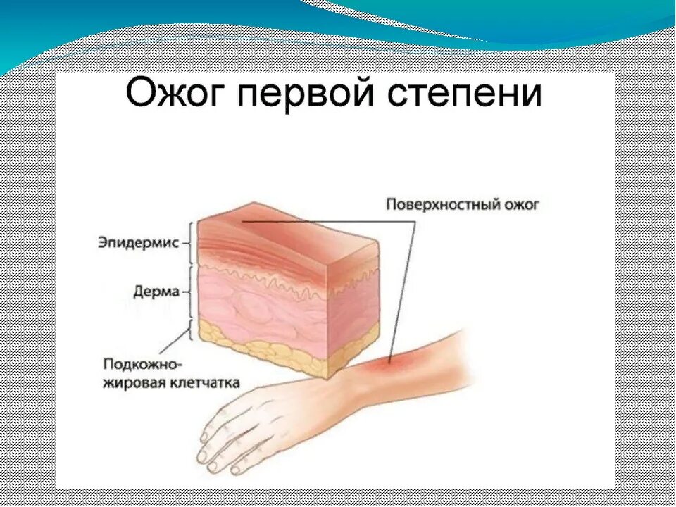 Эффективное лечение ожогов. Клинические проявления термического ожога II степени:. Ожоги термические химические 1 степени.