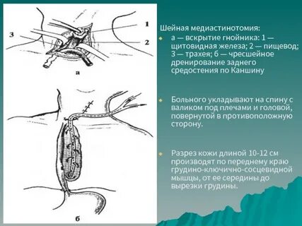 Медиастинит пищевода