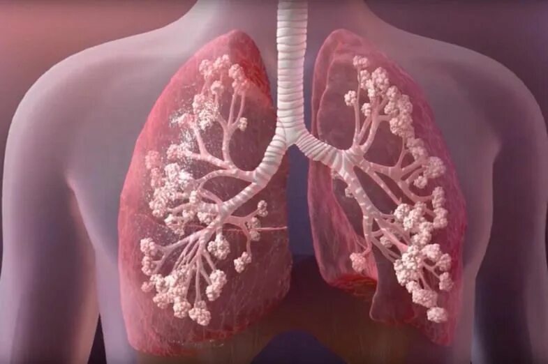 Classification of infectious diseases. Болезнь якоба-крейтцфельдта мозг. Disease from. Вирусные инфекционные заболевания. Вирусные инфекции.
