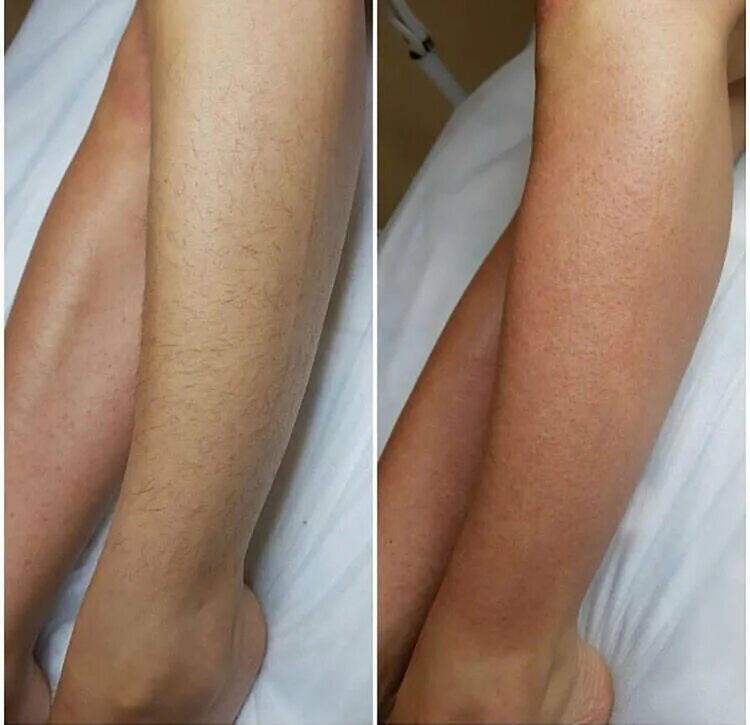 Депиляция ног. Лазерная эпиляция бикини до и после. Эффект от шугаринга. Эффект от шугаринга. Александритовый лазер глубокое бикини.