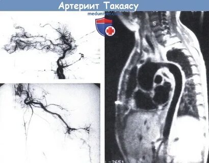 Болезнь такаясу клинические рекомендации