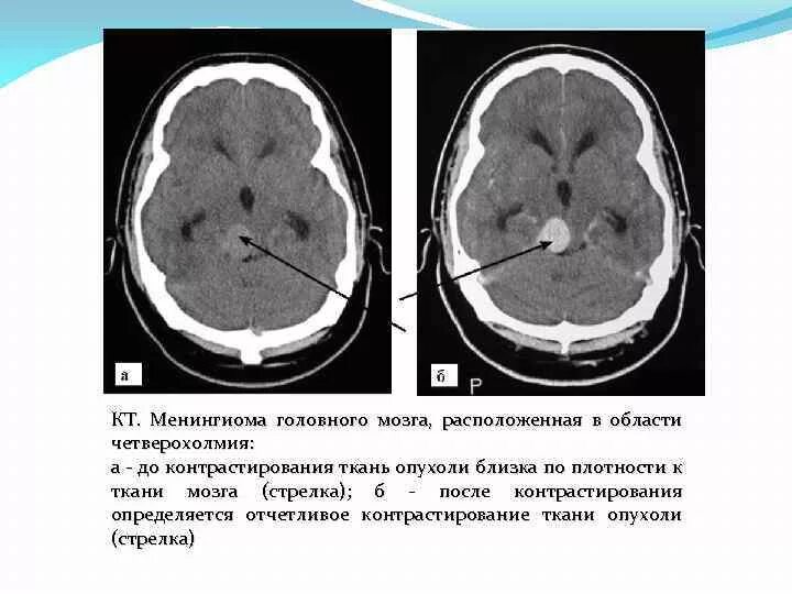 Менингиомы головного мозга на кт. Петрифицированная менингиома. Кальцинированная менингиома лобной доли. После операции менингиомы головного мозга