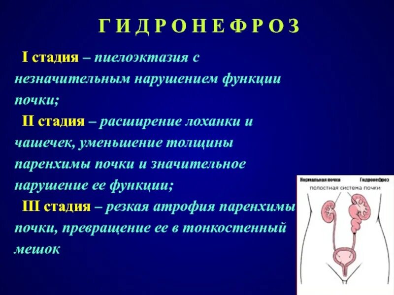 Гидронефроз почки причины. Гидронефроз почки УЗИ протокол. Гидронефроз левой почки 2ст. Пиелоэктазия 1 степени. Незначительные нарушения функций