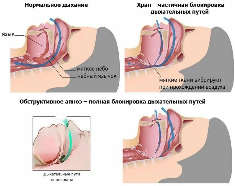 При засыпании останавливается дыхание. Обструктивное ночное апноэ. Синдром обструктивного апноэ сна. Синдром обструктивного апноэ сна сипап терапия. Аропноэ.