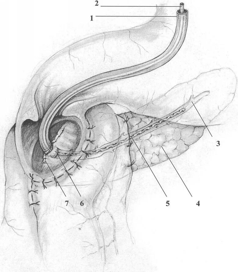 Делают ли операцию на поджелудочную. Наружное дренирование кисты поджелудочной железы. Дренирование псевдокисты поджелудочной железы. Панкреатодуоденальная резекция дренаж. Чрескожное дренирование кисты поджелудочной железы.