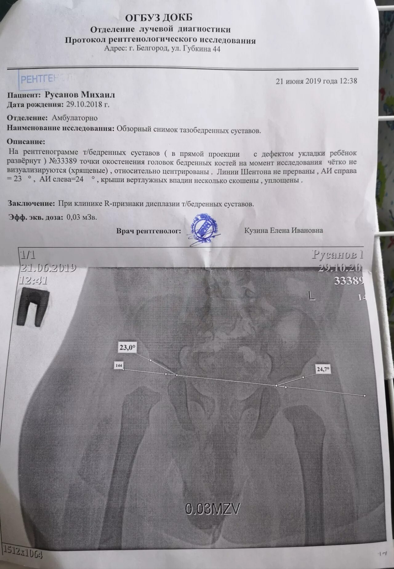 Дисплазия тазобедренных суставов у детей форум. Дисплазия тазобедренных суставов у детей форум