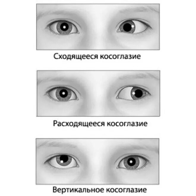 Можно ли вылечить косоглазие. Неаккомодационное сходящееся косоглазие. сходящееся альтернирующее косоглазие. сходящееся альтернирующее косоглазие у детей. содружественное косоглазие схема.