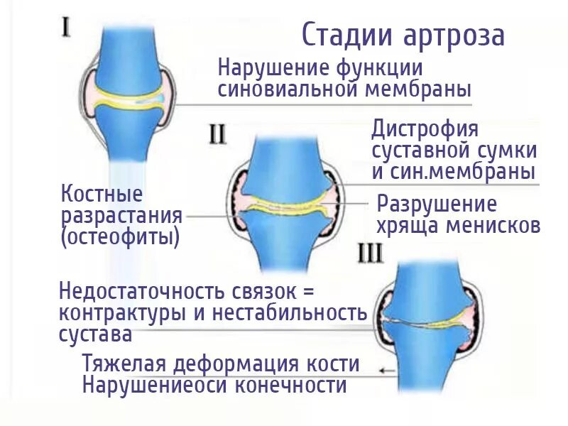 Деформирующий остеоартроз коленного сустава 1. Остеоартроз рентгенологические стадии. стадии остеоартроза коленного сустава. стадии деформирующего артроза. артроз коленного сустава степени.