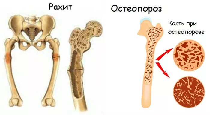 рахит остеомаляция остеопороз. кость человека прочнее. остеопороз презентация. насколько крепка кость человека. изменение костей при рахите.