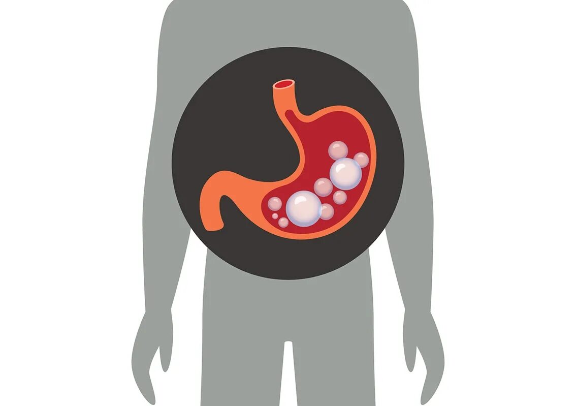 Метеоризм симптомы. Углекислый ГАЗ В желудке. ГАЗЫ скапливаются в желудке.