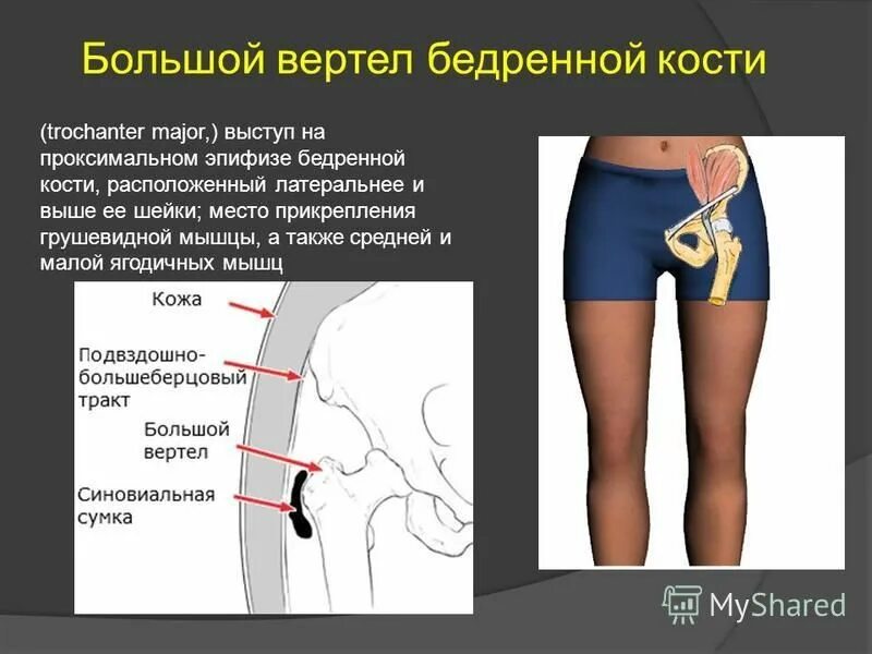 Бедра женщины фото где находится. Большой вертел бедренной кости. Большой вертел бедренй клсьи.