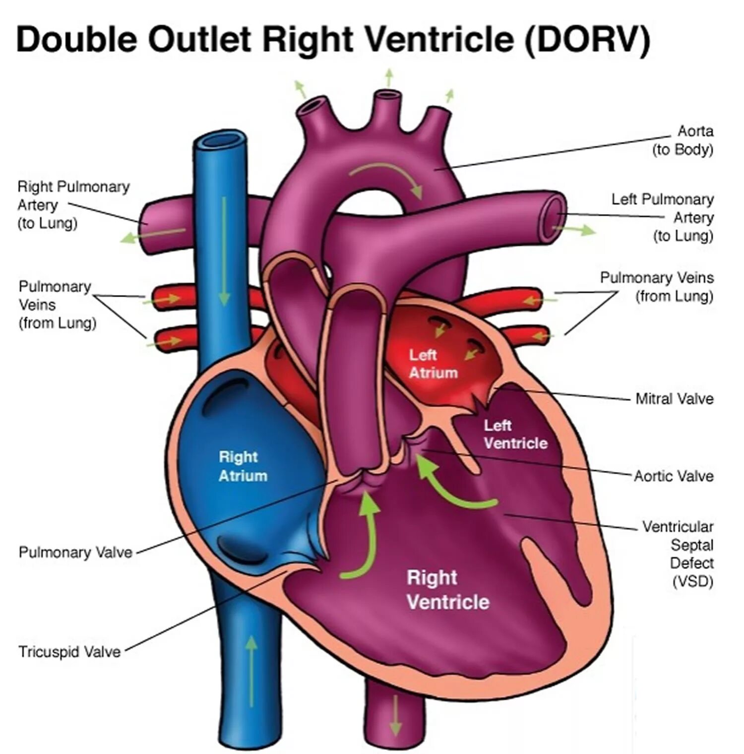 Double right. Double outlet right ventricle. left ventricle. right ventricle. dorv.