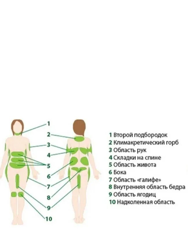 Зоны липосакции на теле схема. Зоны для миостимуляции схема. Проблемные зоны тела у женщин. Зоны для криолиполиза. Проблемные зоны тела у женщин.