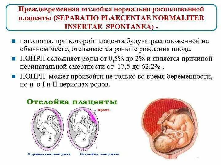 Отслойка нормальной плаценты. Причины преждевременной отслойки нормально расположенной плаценты. Центральная отслойка плаценты. Преждевременная отслойка нормально расположенной плаценты узи. Отслойка нормальной плаценты.