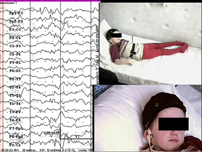 Видео ээг ночной. ЭЭГ ВМ дневного сна. ЭЭГ головного мозга видеомониторинг. Видеомониторинг ЭЭГ 4 часовой. Суточный видеомониторинг ЭЭГ.