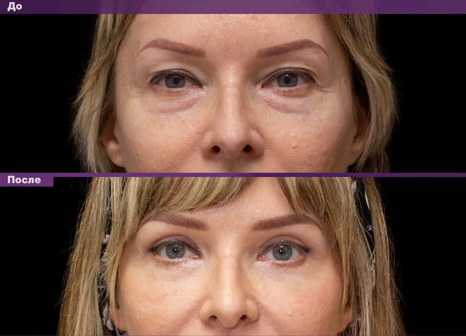 Круговая блефаропластика фото отзывы. Круговая блефаропластика фото отзывы. Круговая блефаропластика до и после. Блефаропластика нижних век до и после. Круговая пластика глаз.