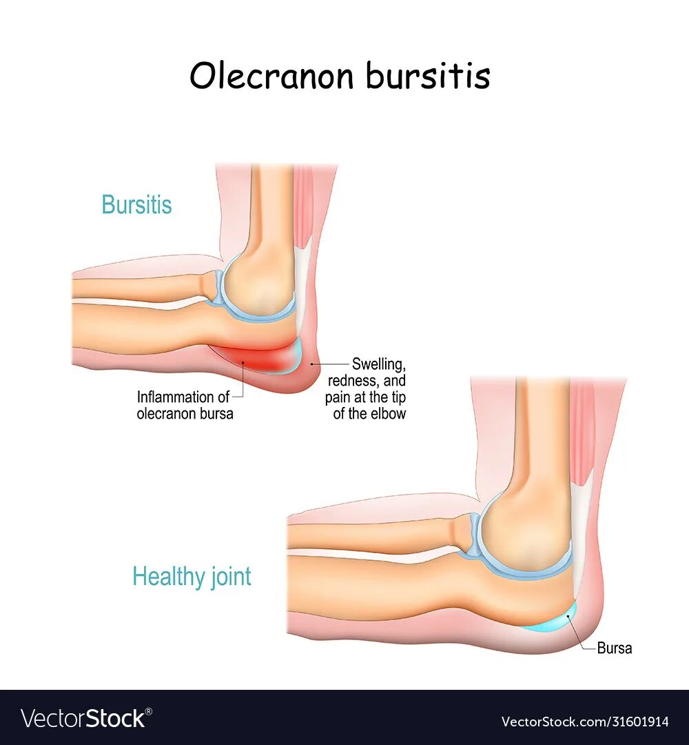 Эффективное лечение бурсита локтевого. Бурса локтевого сустава анатомия. Олекранон локтевой.
