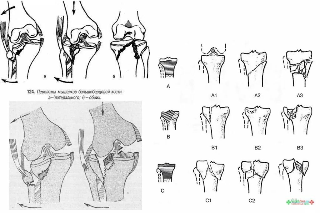 Перелом большой берцовой мыщелки. Переломы мыщелков большеберцовой кости классификация. Латеральный мыщелок большеберцовой кости перелом. Перелом латерального мыщелка большеберцовой кости классификация. Перелом бокового мыщелка большеберцовой кости.