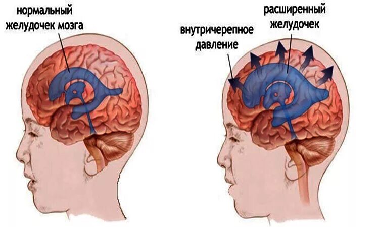 Внутричерепное давление головного мозга