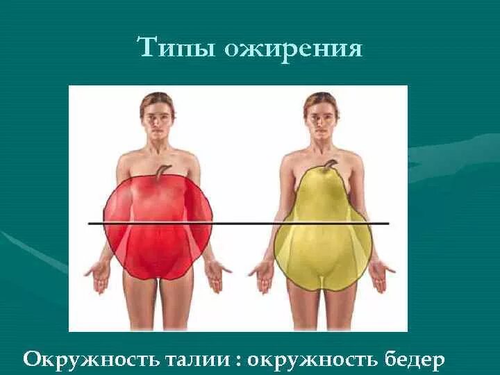 Типы ожирения. Смешанный Тип ожирения. Женский Тип ожирения.